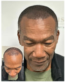Hairline Restoration Bundle
