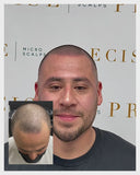 Hairline Restoration Bundle