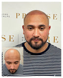 Scalp Micropigmentation 3-Session Bundle