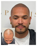 Scalp Micropigmentation 3-Session Bundle