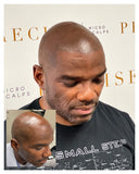 Scalp Micropigmentation 3-Session Bundle