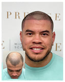 Scalp Micropigmentation 3-Session Bundle