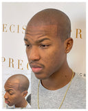 Hairline Restoration Bundle