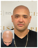 Scalp Micropigmentation 3-Session Bundle