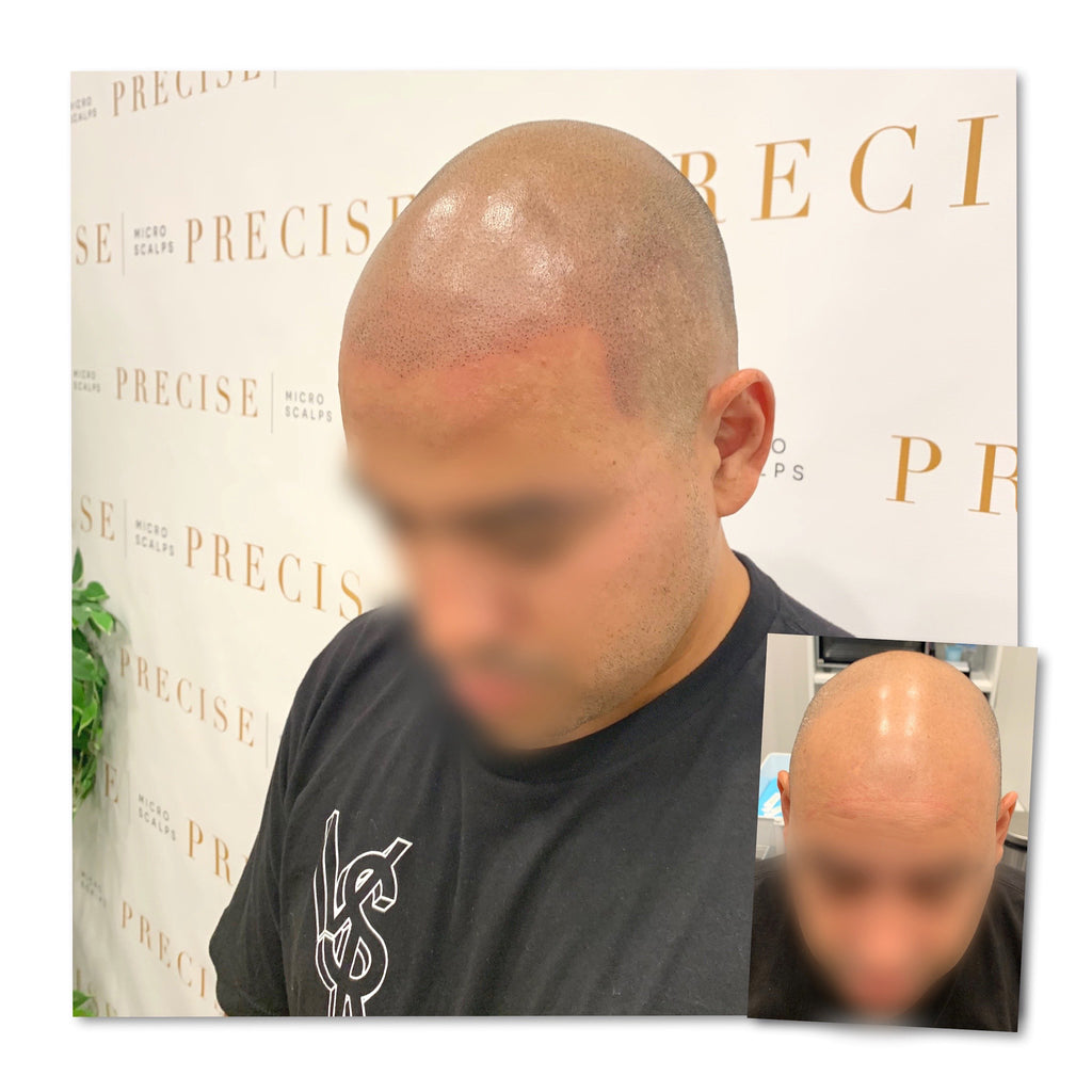 Scalp Hair Follicle Simulation Paramedical Tattoo Micropigmentation by  Expert Services by Teresa, West Palm Beach,… | Scalps, Scalp  micropigmentation, Hair follicle